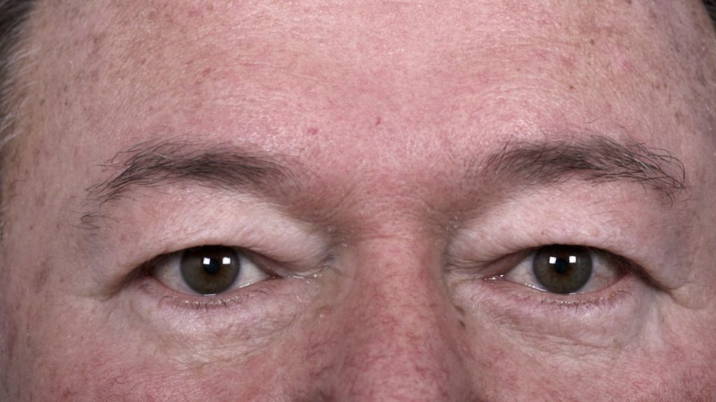 Patient before eyelid surgery