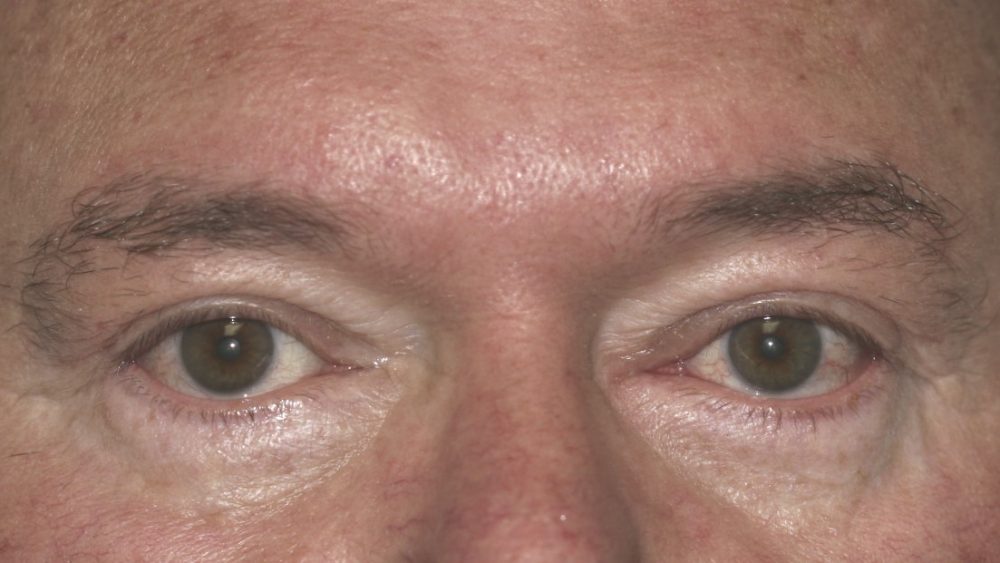 A Complete Look at Upper Eyelid Surgery (Blepharoplasty) Richard