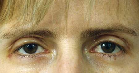 Female patient five days after surgery procedure. Scars on upper eyelids have disappeared.
