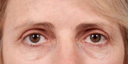 Female patient 20 years after eyelid surgery, still retaining the symmetrical eyelids and with no bags!