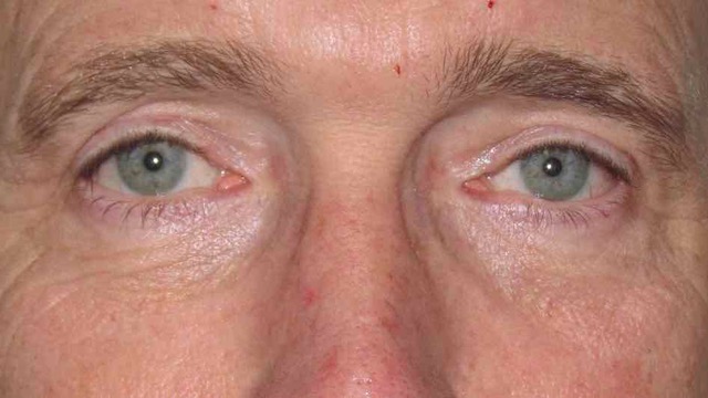 Male patient after upper and lower eyelid surgery