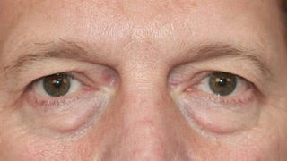 Male patient before upper and lower eyelid surgery