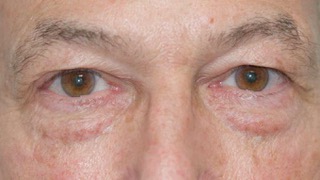 Male patient before eyelid surgery