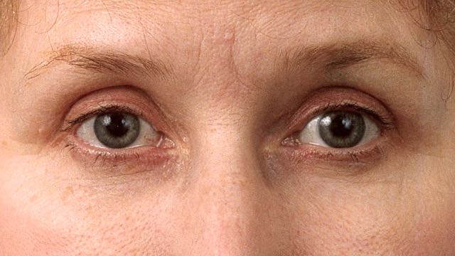 Female patient after upper and lower eyelid surgery.