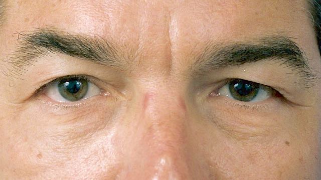 Male patient before upper and lower eyelid surgery.