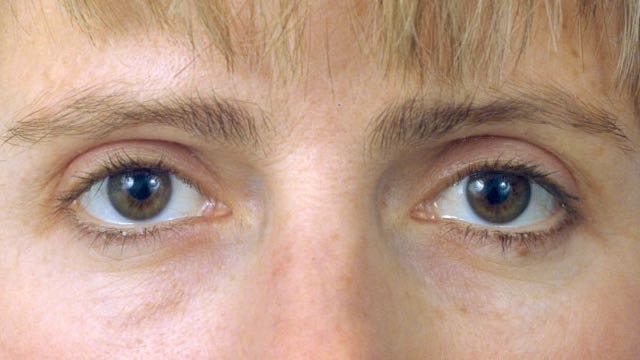 Female patient after upper and lower eyelid surgery