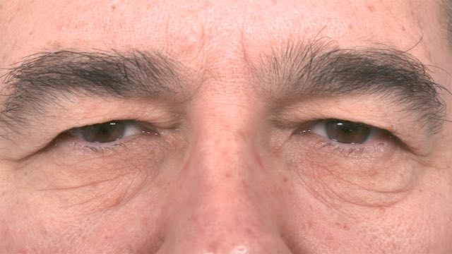 Male patient before upper and lower eyelid surgery. Patient presents with significant upper lid "hooding".