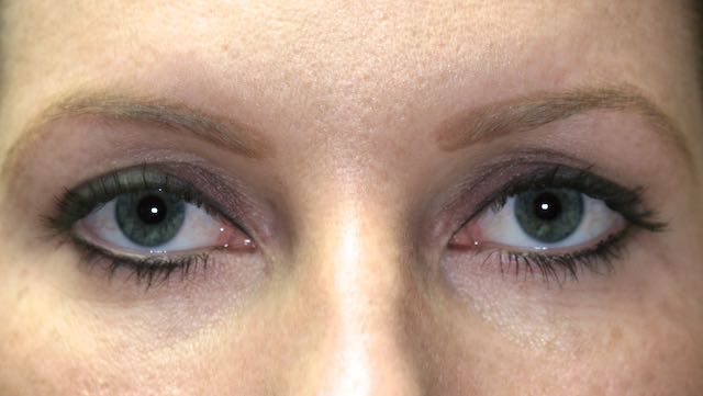 Female patient before upper eyelid surgery.