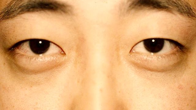 Asian male patient #22 before upper and lower eyelid surgery.