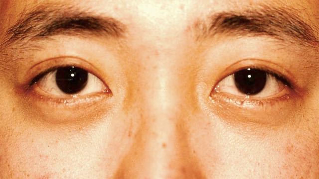 Asian male patient #22 after upper and lower eyelid surgery.