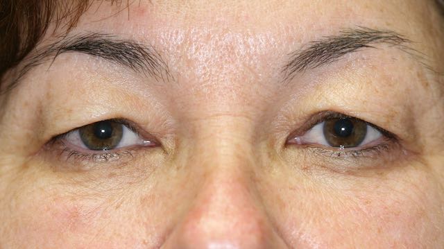 Female patient #23 before upper and lower eyelid surgery. The patient has heavy upper eyelids that rest on her eyelashes.