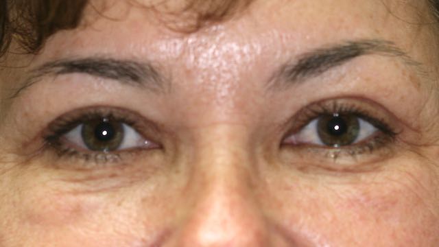 Female patient #23 after upper and lower eyelid surgery.