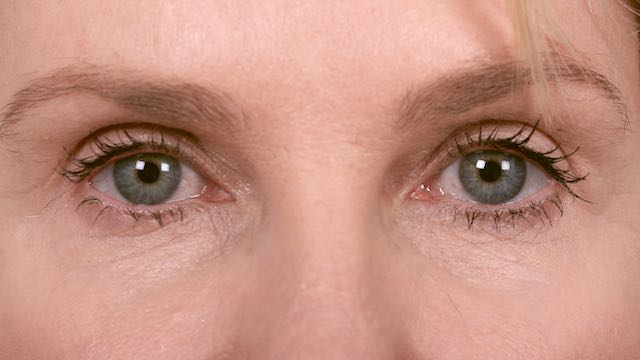 Female patient after upper eyelid surgery.