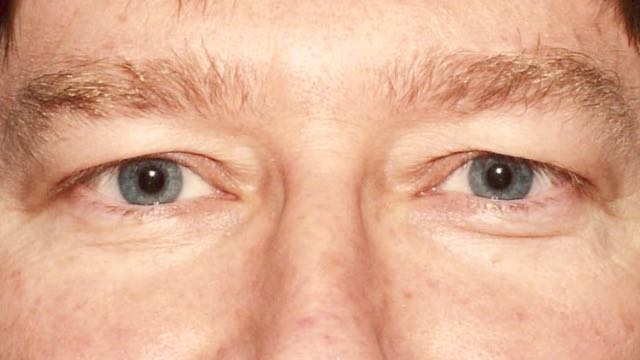 Male patient before upper and lower eyelid surgery.