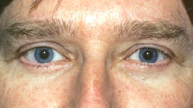Male patient after upper and lower eyelid surgery.