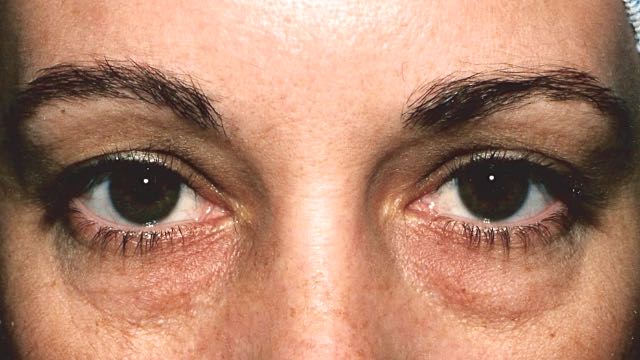 Female patient before upper and lower eyelid surgery.