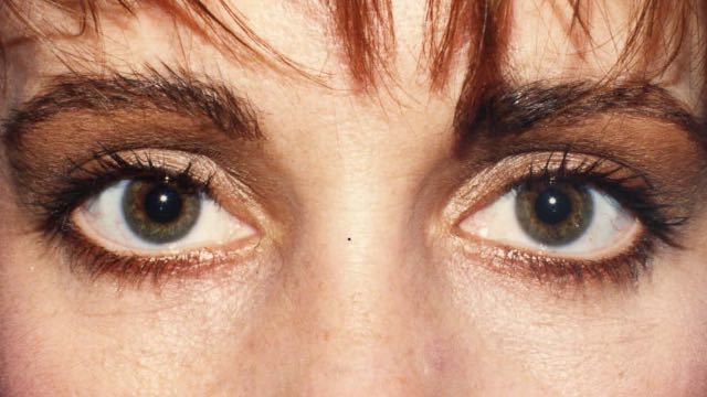 Female patient after upper and lower eyelid surgery.
