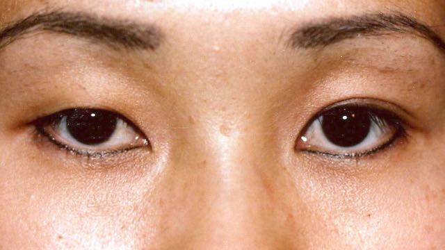 Female patient before upper eyelid surgery to create upper eyelid crease on the right eyelid.