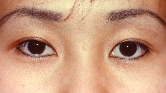 Female patient after upper eyelid surgery to create upper eyelid crease on right eyelid.