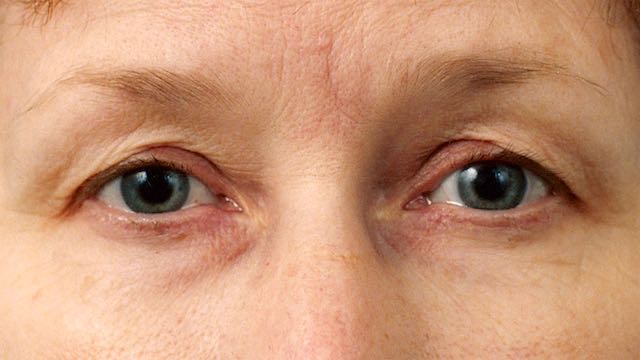 Female patient before upper and lower eyelid surgery.