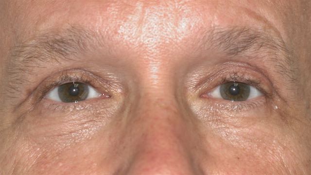 Patient 38 had upper lid blepharoplasty to remove the heavy lid appearance. The excess skin, fat and brow fat were excised the lower lid fat was also removed from behind the eyelid approach. His appearance is now rejuvenated and more alert.