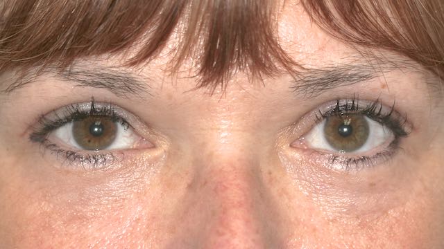 Patient 39 has had upper and lower cosmetic eyelid surgery, under local anesthesia in our office surgical suite. After removing the skin and fullness of the upper eyelids, and removing the fat of the lower eyelids from behind the eyelid with no skin incision. She looks more alert and welll rested.