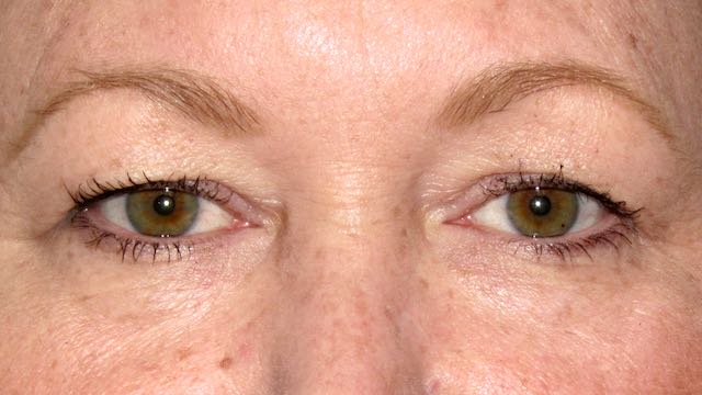 Patient 41 had upper lid blepharoplasty to create a lid platform. The fat in lower eyelids was removed from behind the lower lid with no skin incision. A very nice result was achieved.