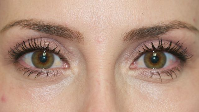 Patient 52 had cosmetic upper eyelid blepharoplasty to remove the excess skin and fullness of her upper eyelids. She appears more youthful and refreshed after surgery.