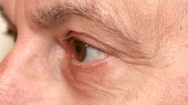 cosmetic eyelid surgery blepharoplasty75b
